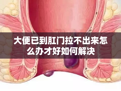 大便已到肛门拉不出来怎么办才好如何解决